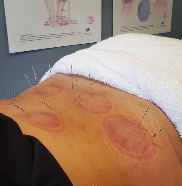 sports acupuncture and cupping