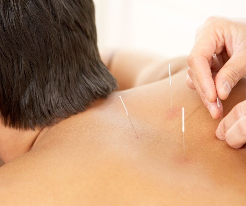 Sports Recovery Treatments With Acupuncture And Cupping Featured Image